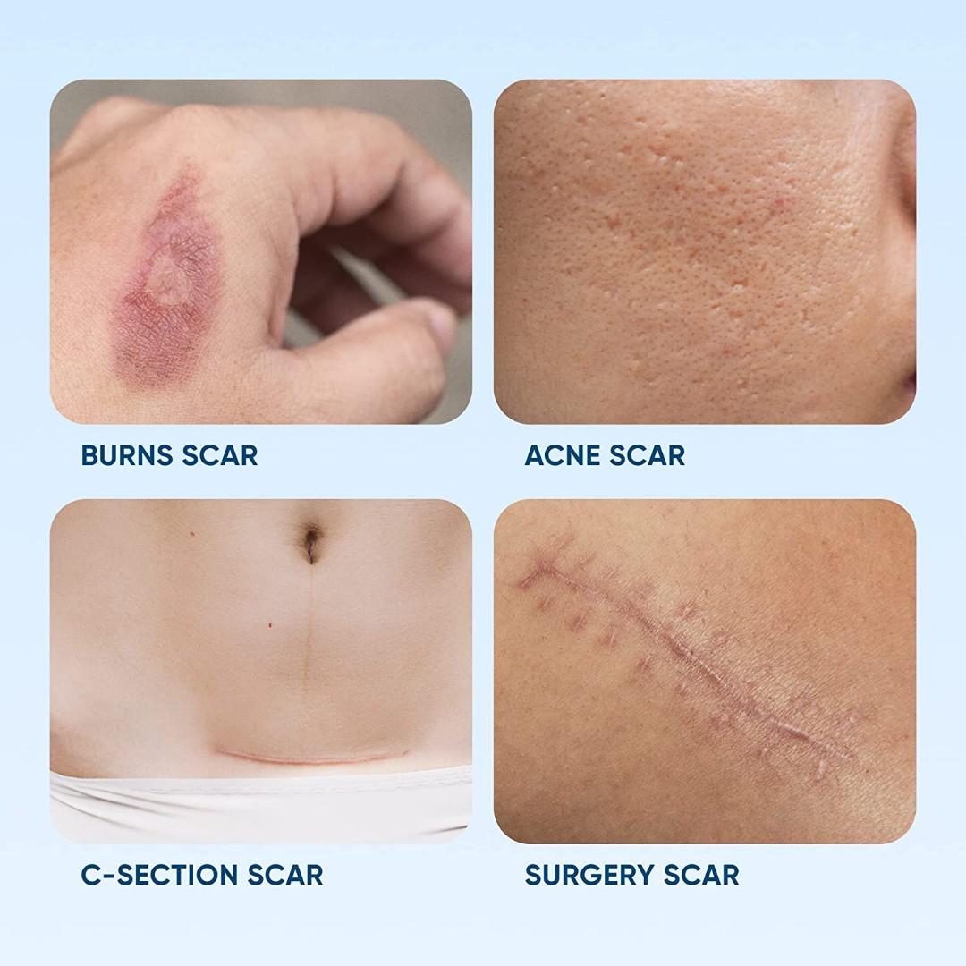 Silicone Scar Removal Sheets Breathable Reusable Waterproof