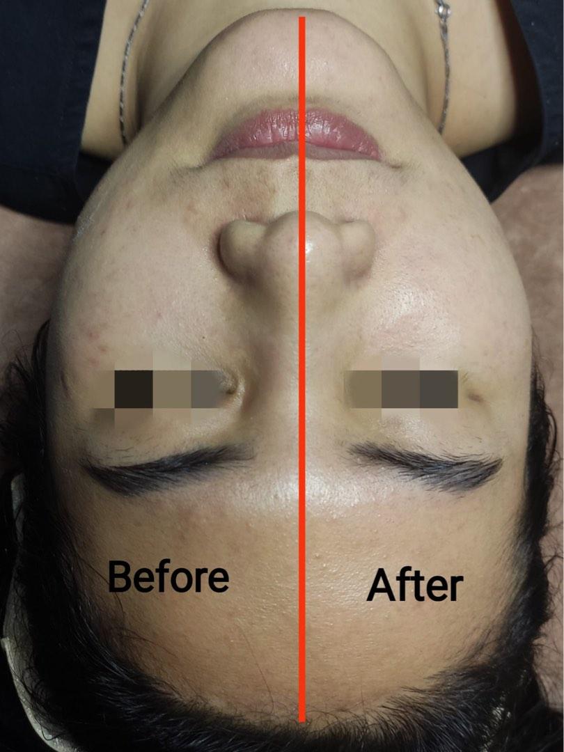 FacialEye Treatment AcnePimpleAnti Aging Lifting, Beauty