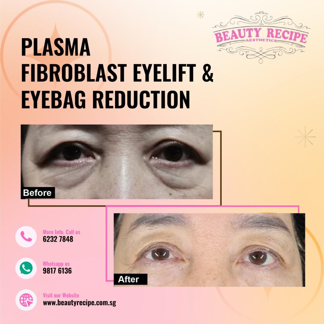 Double Chin / Cheek / Jaw / Forehead / Smile Line Nasolabial Fold