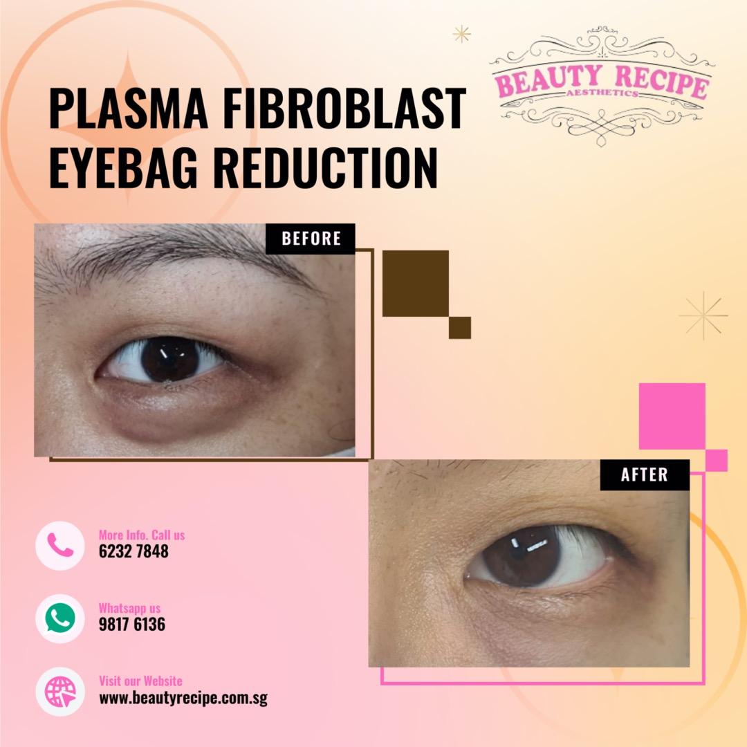 Double Chin / Cheek / Jaw / Forehead / Smile Line Nasolabial Fold