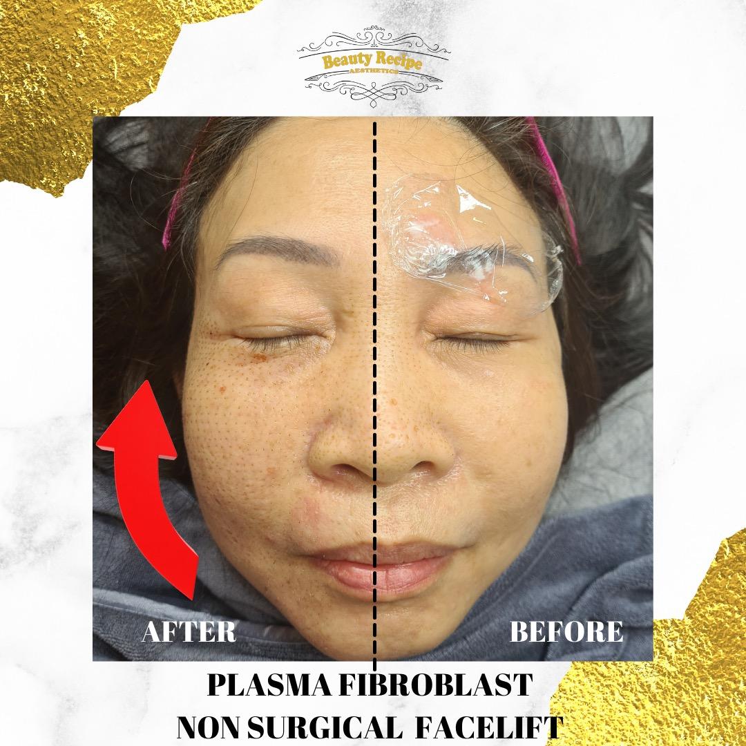 Double Chin / Cheek / Jaw / Forehead / Smile Line Nasolabial Fold