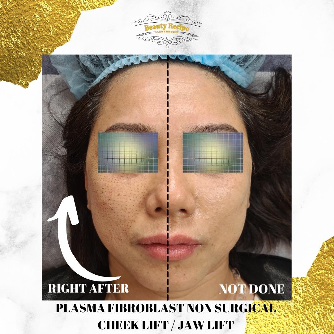 Double Chin / Cheek / Jaw / Forehead / Smile Line Nasolabial Fold