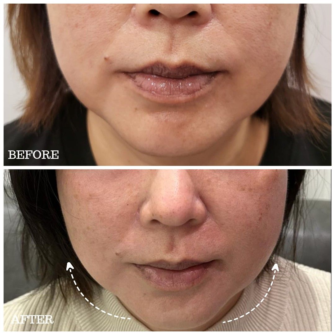 Double Chin / Cheek / Jaw / Forehead / Smile Line Nasolabial Fold