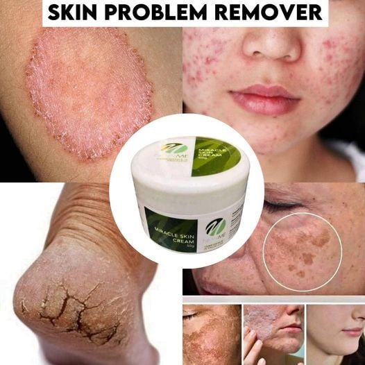 BUY 1 TAKE 1 New Me Cream . Remove all types of skin problem!, Beauty ...