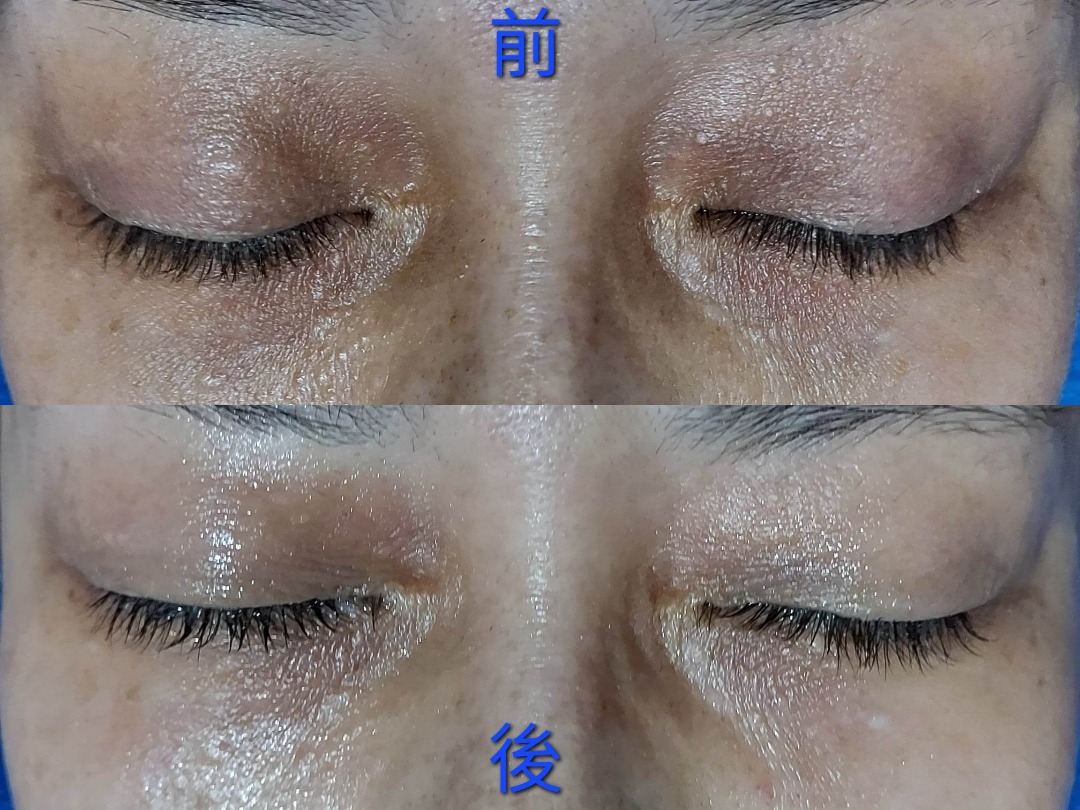 👀《拜拜》眼袋及熊貓眼👀一次見效！RF射頻眼部療程- 觀塘62863125567235112