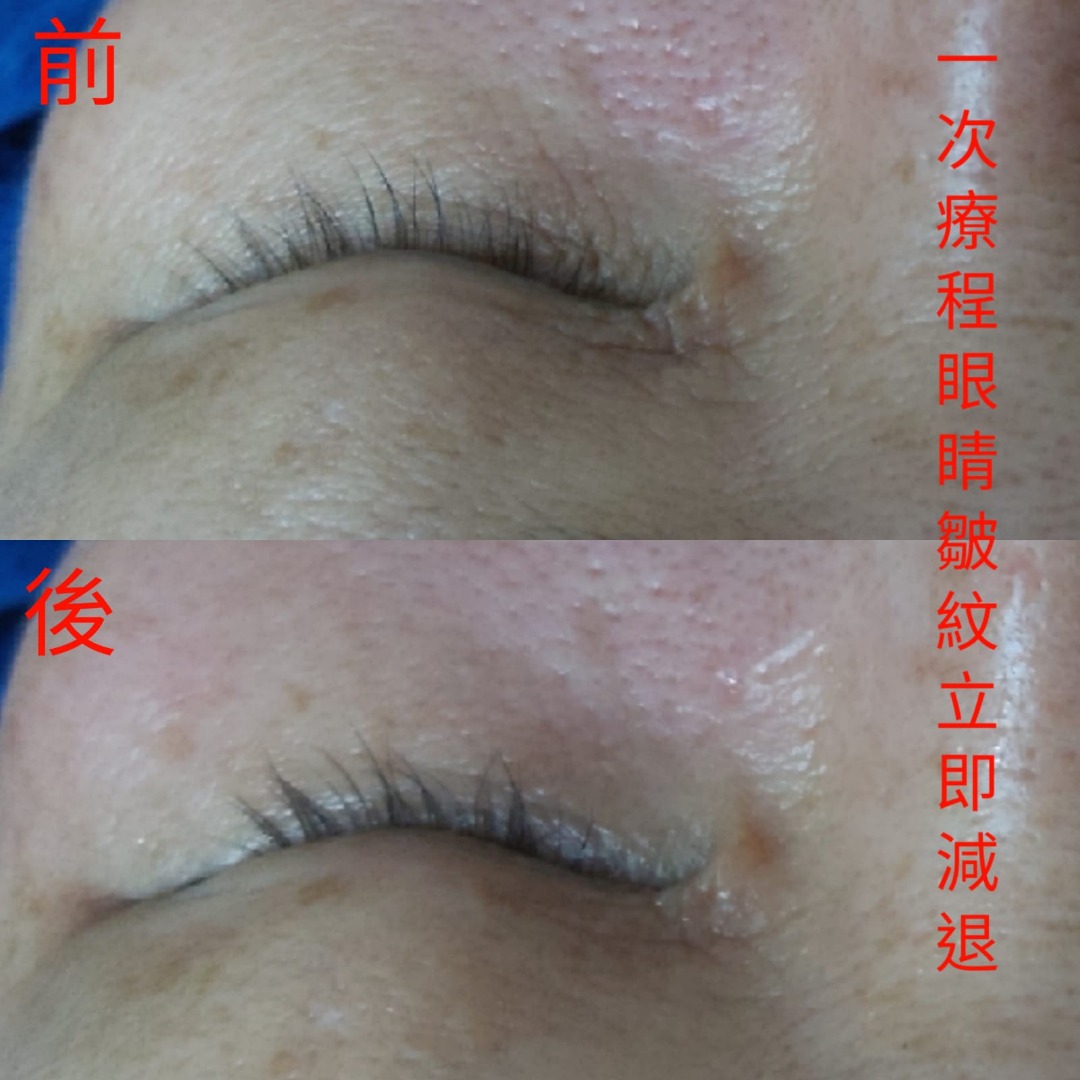 👀《拜拜》眼袋及熊貓眼👀一次見效！RF射頻眼部療程- 觀塘62863125567235111
