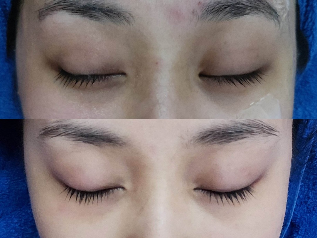 👀《拜拜》眼袋及熊貓眼👀一次見效！RF射頻眼部療程- 觀塘62863125567235114