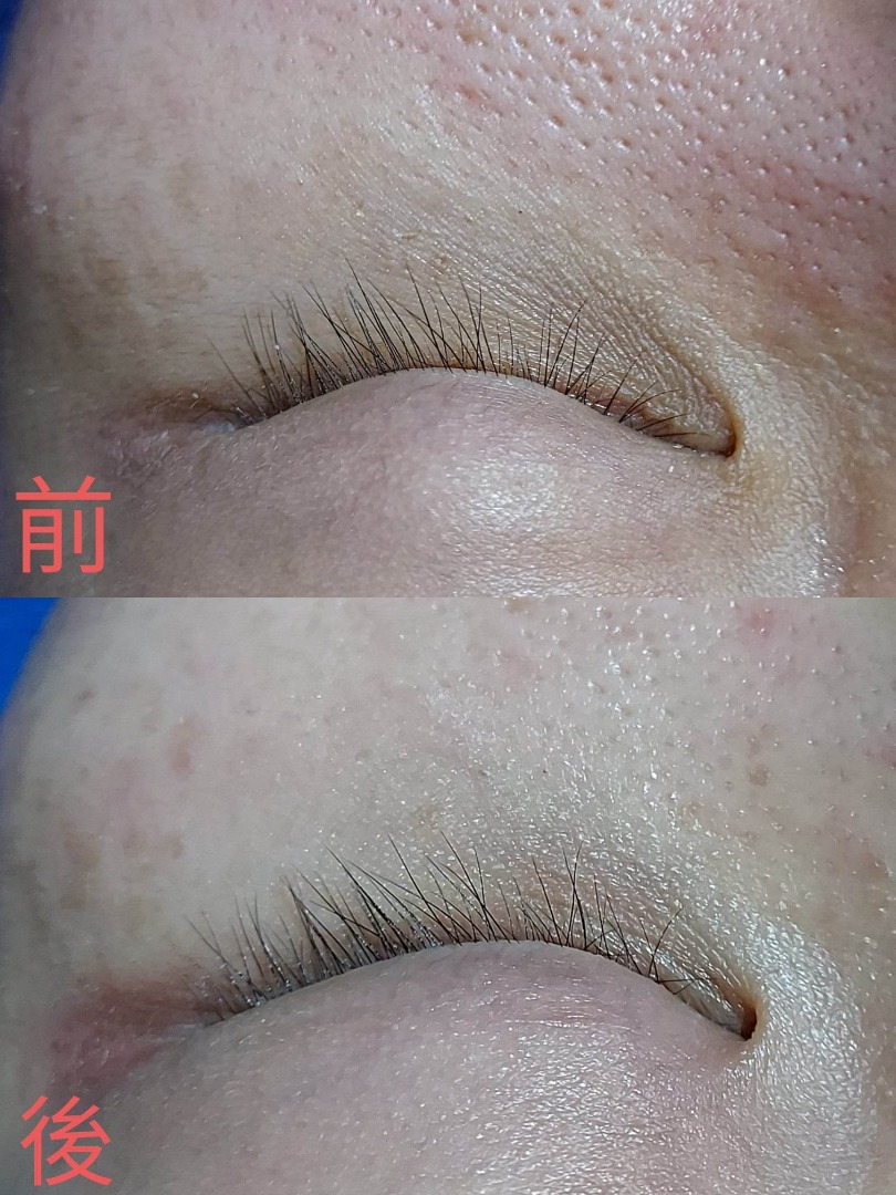 👀《拜拜》眼袋及熊貓眼👀一次見效！RF射頻眼部療程- 觀塘62863125567235113