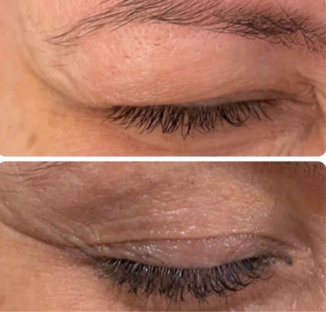 JAN Promo: FDA & HSA approved Medical Grade Eyelids Lift Treatment (Non