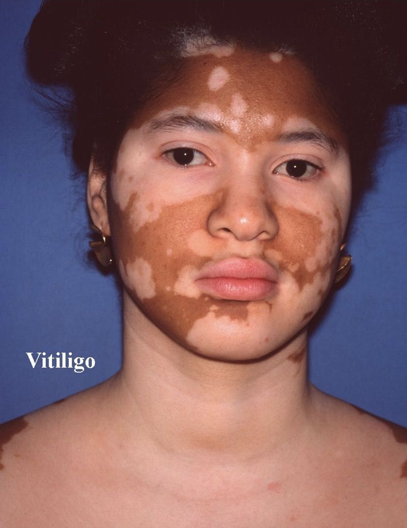 Vitiligo Treatment Medicalgrade Hydroquinone Cream, Beauty
