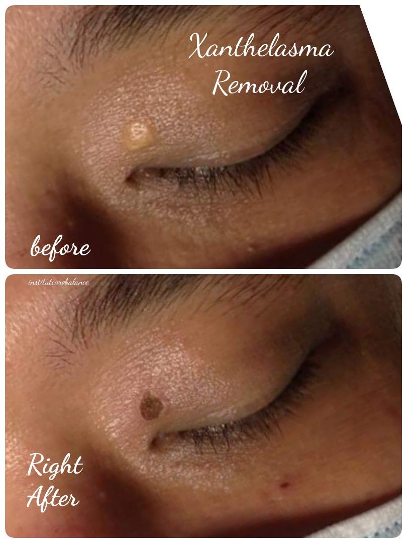 Milia Seed﻿,Skin Tag,Wart﻿,Syringoma,Tiny Bump,Oil Clog,Xanthelasma