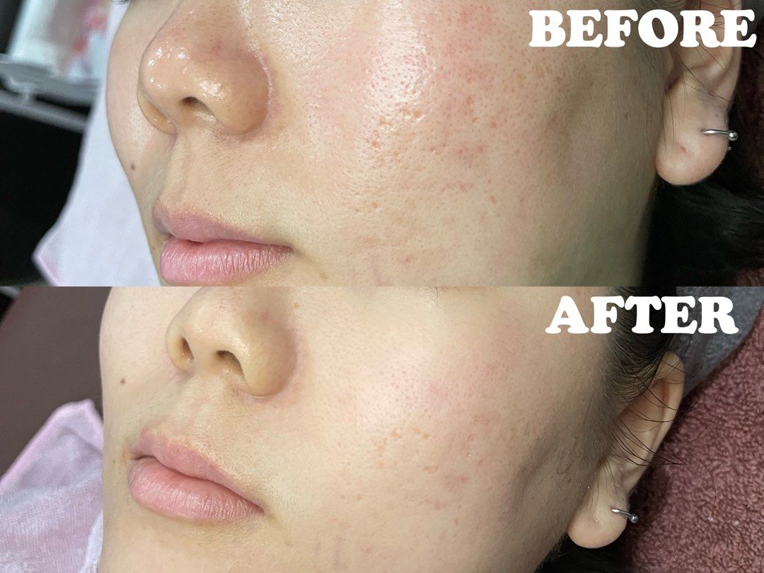 BB Glow @ $60 (Category: Beauty & Health Services) located in Singapore. Submitted by fabulousfantsy (Listing ID 1199165366, Image 2). Description: BB Watershine Glow @ $60 (first-timer)! Recurring customers @ $68 Helps to lighten scars, improve uneven skin tone & brighten up your skin ! DM me to enquire for dates / timings! Home-based @ Boon Keng Include: Double cleansing, exfoliation, application of BB ampoule with MTS needle, Dr Jart cooling m