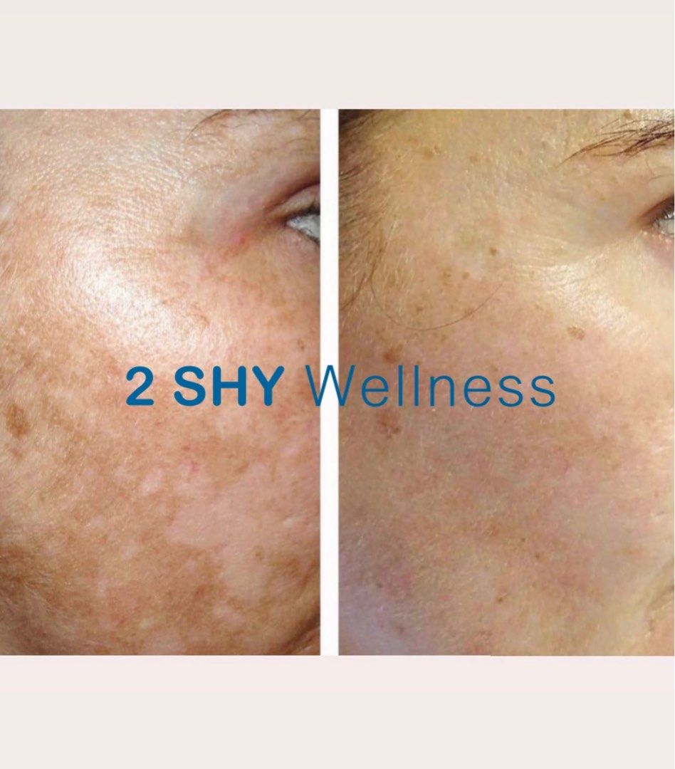 SEP Promo Pigmentations (sunspots, dermal spots & melasma