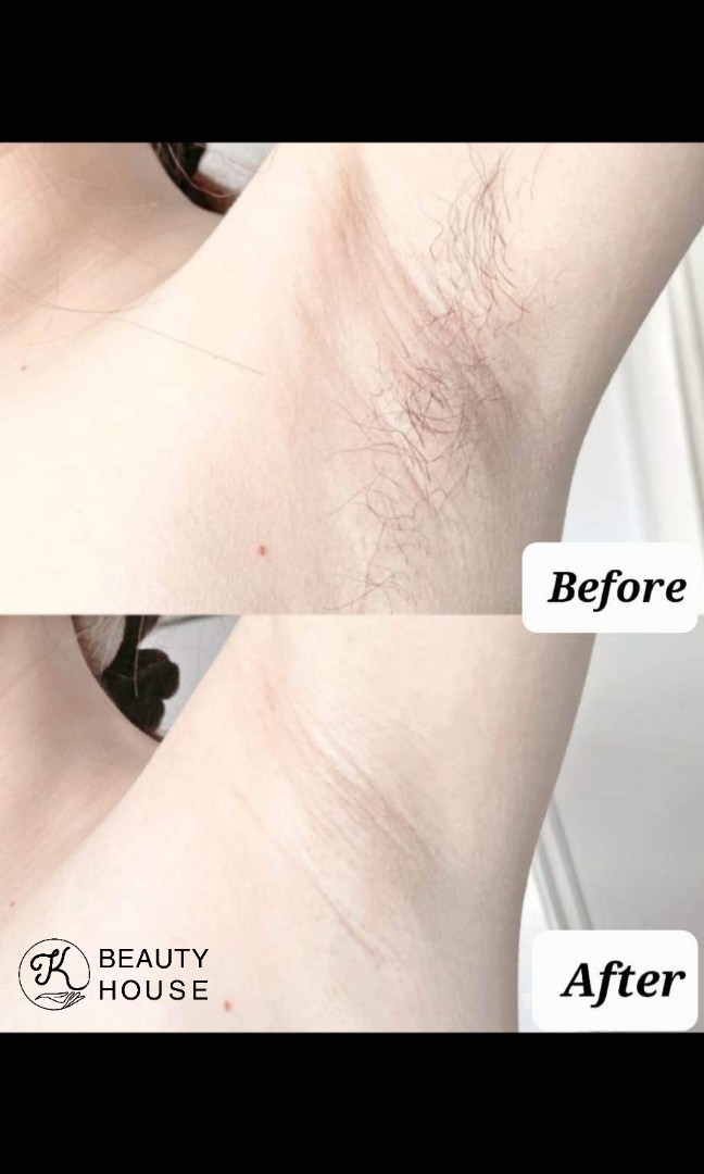 OPT hair removal whitening underarm and skin rejuvenation acne facial,  Beauty & Personal Care, Face, Face Care on Carousell