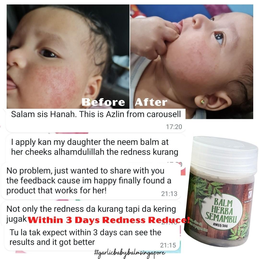 SEMAMBU SET ( NEEM SET ) NEEM SOAP / NEEM LOTION / NEEM BALM for ECZEMA