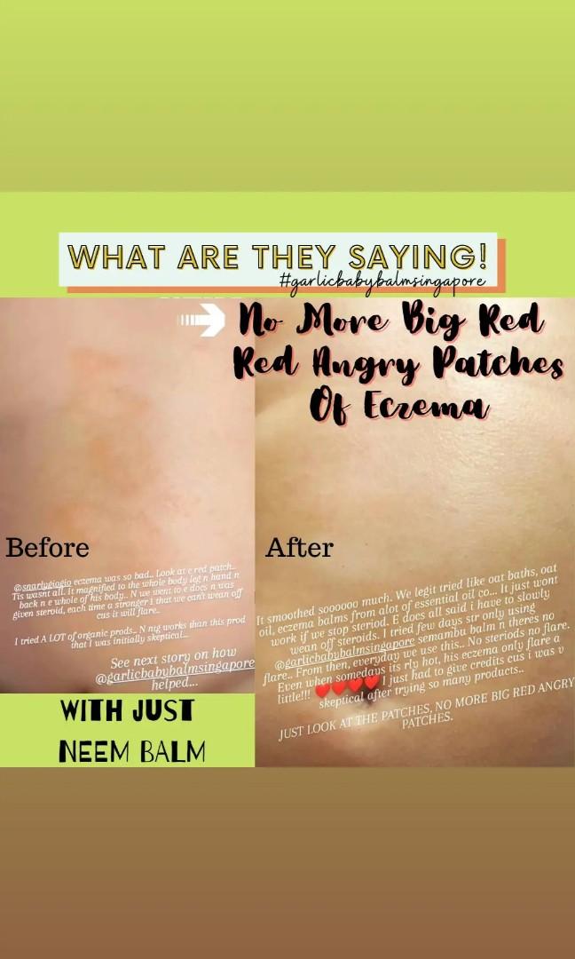 SEMAMBU SET ( NEEM SET ) NEEM SOAP / NEEM LOTION / NEEM BALM for ECZEMA