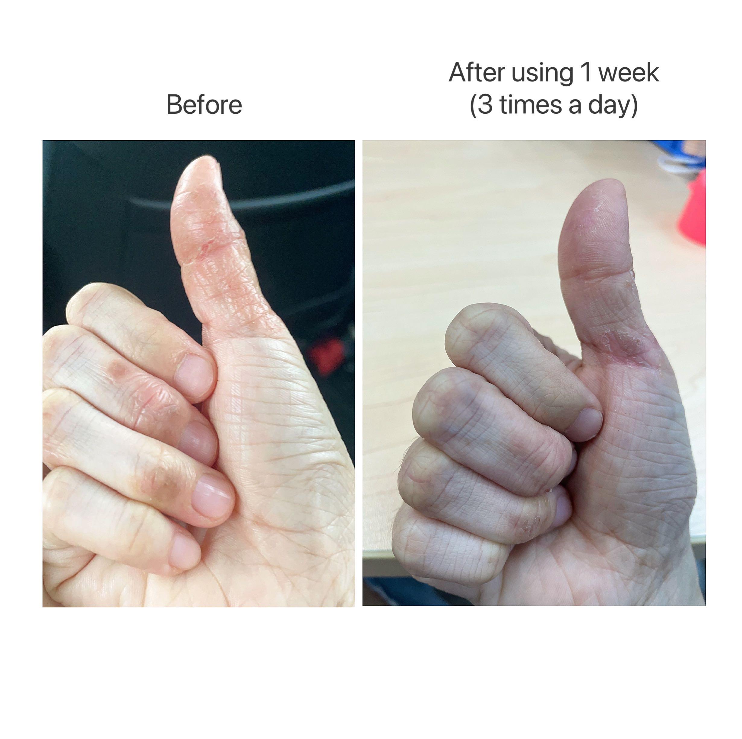 Eczema Pompolyx Dyshidrotic Healing Cream, Beauty & Personal Care, Bath & Body, Body Care on