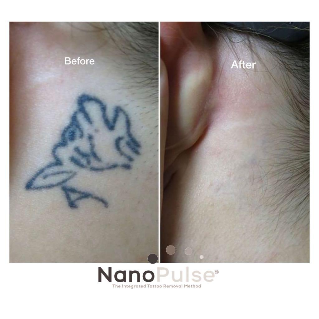 Small Size Body Tattoo removal , Lifestyle Services, Beauty & Health