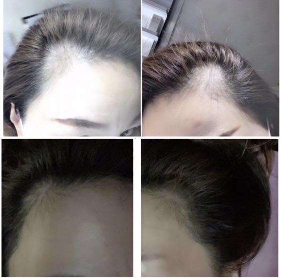 Xmas Promo Hair loss / sensitive scalp shampoo / hair Essence, Beauty &  Personal Care, Hair on Carousell
