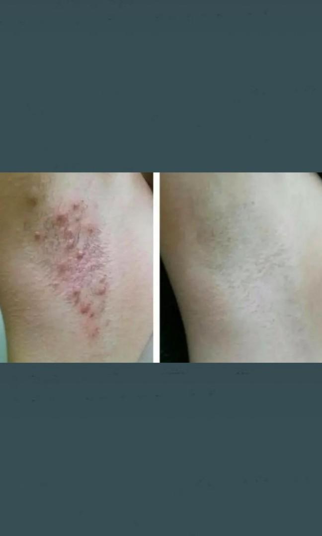 Laser hair removal underarms, Beauty & Personal Care, Hair on Carousell