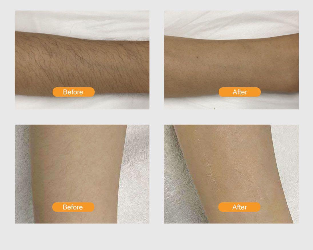 IPL/ Diode laser for boyzilian/ Brazilian/Skin Whitening & SHR Hair