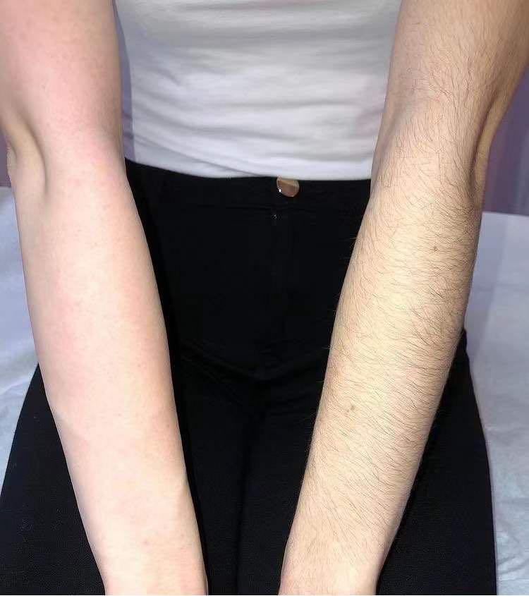 IPL/ Diode laser for boyzilian/ Brazilian/Skin Whitening & SHR Hair