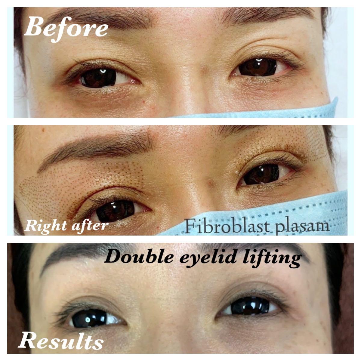 Double online eyelid stretch