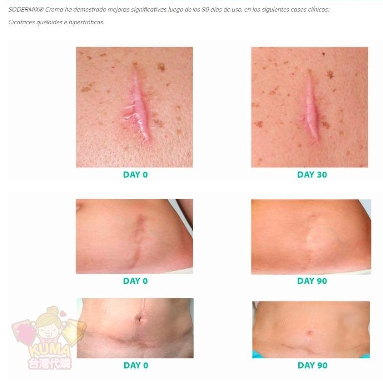 台灣代購 法國lsi Sodermix 速得美乳霜sodermix Cream 15g 30g裝 蟹足腫 異位性皮膚炎 牛皮癬 魚鱗癬 蕁麻疹等皆適用 有效抗發炎搔癢 纖維化 不含類固醇 美容 化妝品 健康及美容