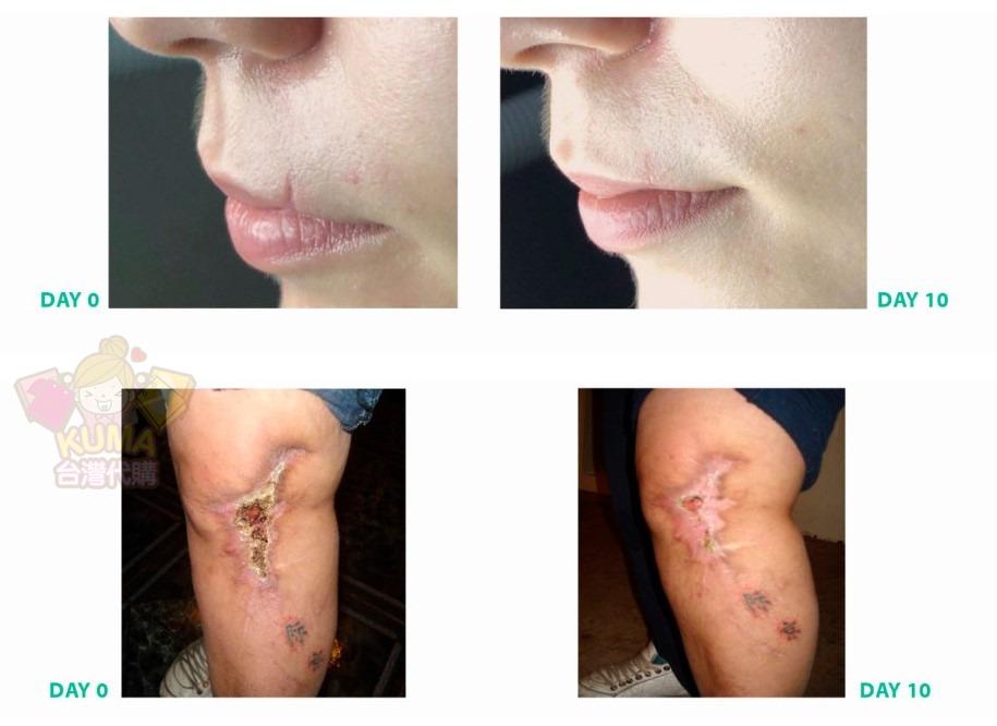 台灣代購 法國lsi Sodermix 速得美乳霜sodermix Cream 15g 30g裝 蟹足腫 異位性皮膚炎 牛皮癬 魚鱗癬 蕁麻疹等皆適用 有效抗發炎搔癢 纖維化 不含類固醇 美容 化妝品 健康及美容