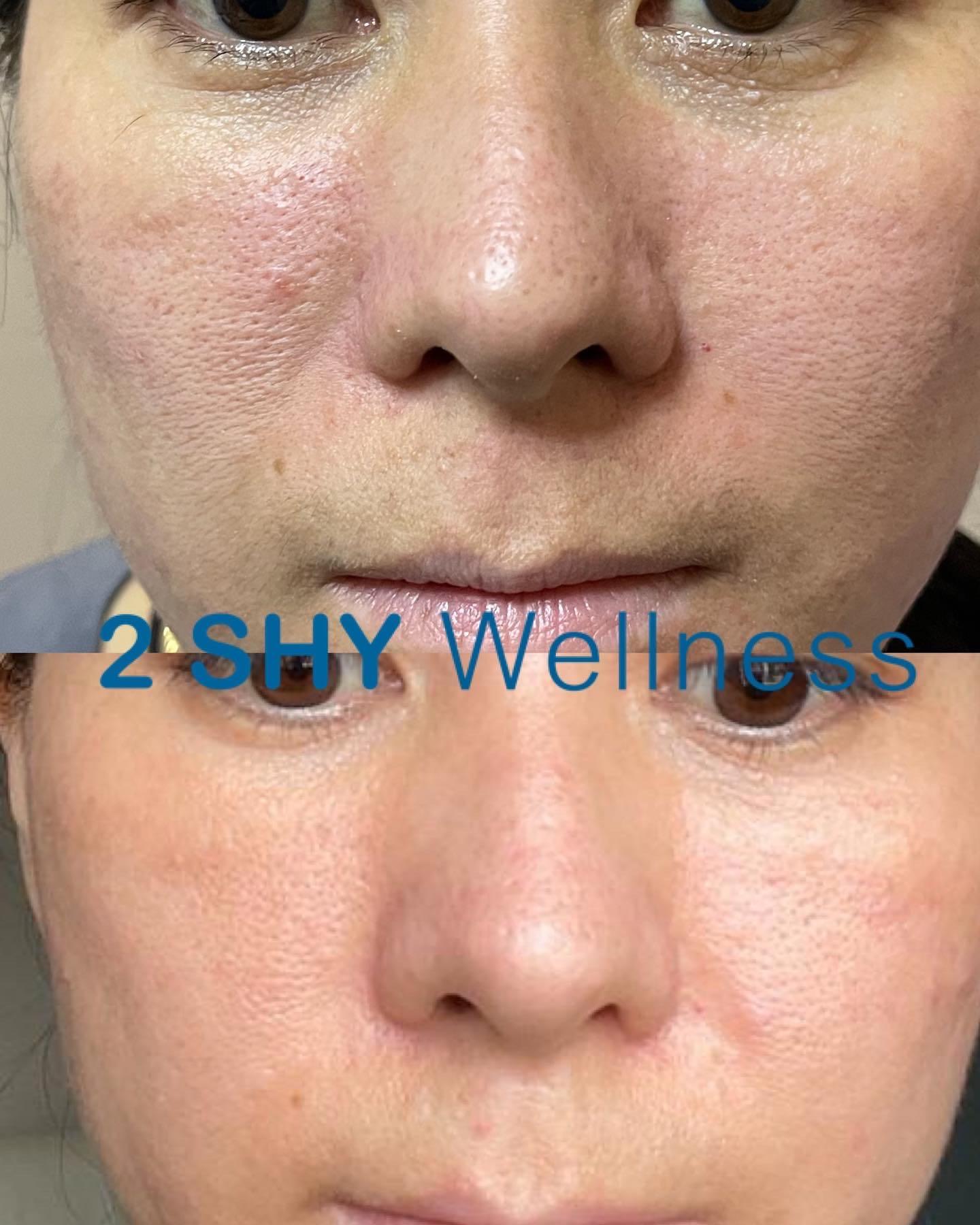 Hari Raya promo Enlarged pore treatment 100 result. Small scars, Skin