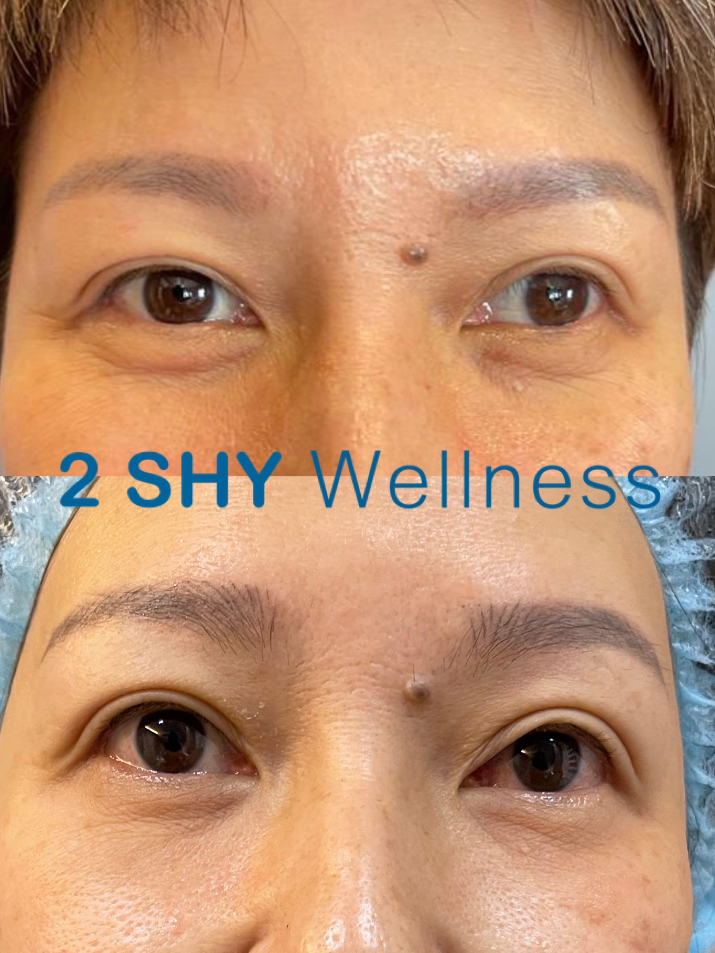 JAN Promo: FDA & HSA approved Medical Grade Eyelids Lift Treatment (Non