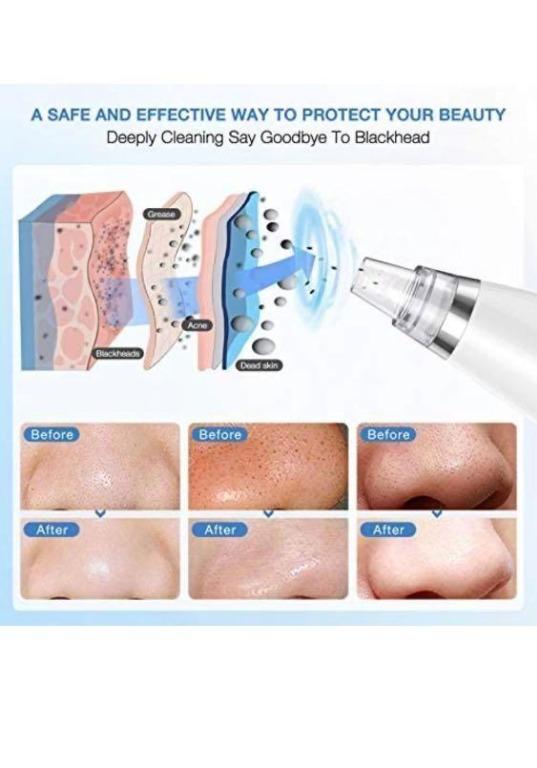 BESTOPE Blackhead Remover Pore Vacuum with Heating and Vibration