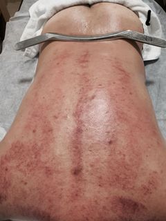 筋膜刀療程+手法64168869989379110