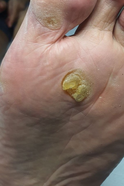 Callus, Corns Home Treatment / Removal Dermtherapy, Beauty & Personal