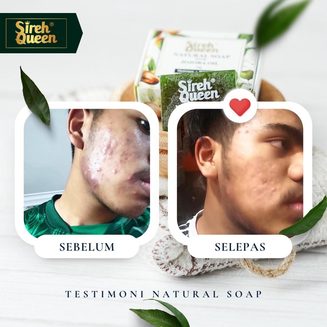 KKM approved sireh soap for acnes, Beauty & Personal Care, Face, Face