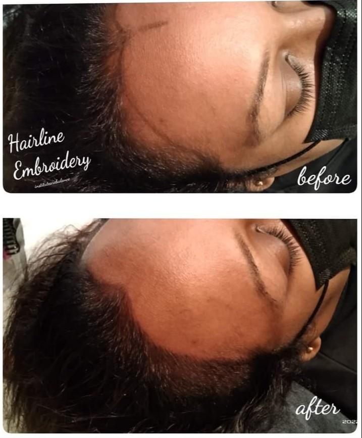 Hairline Embroidery, Beauty & Personal Care, Face, Face Care on Carousell