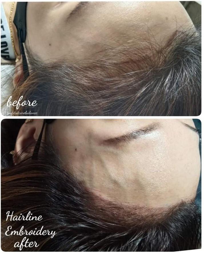 Hairline Embroidery, Beauty & Personal Care, Face, Face Care on Carousell
