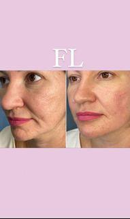 HIFU face and body lifting
