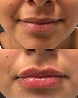 Lip fillers injectables