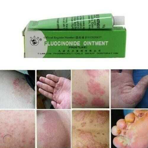 [BUNDLE OF 10 TUBES] ECZEMA CREAM / Fungal Infection / Bacterial Infection / Skin Inflammatory