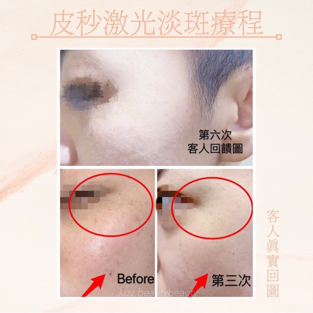Pico Laser皮秒激光嫩膚去斑療程, 美容&個人護理, 健康及美容 - 皮膚護理, 面部 - 面部護理 - Carousell