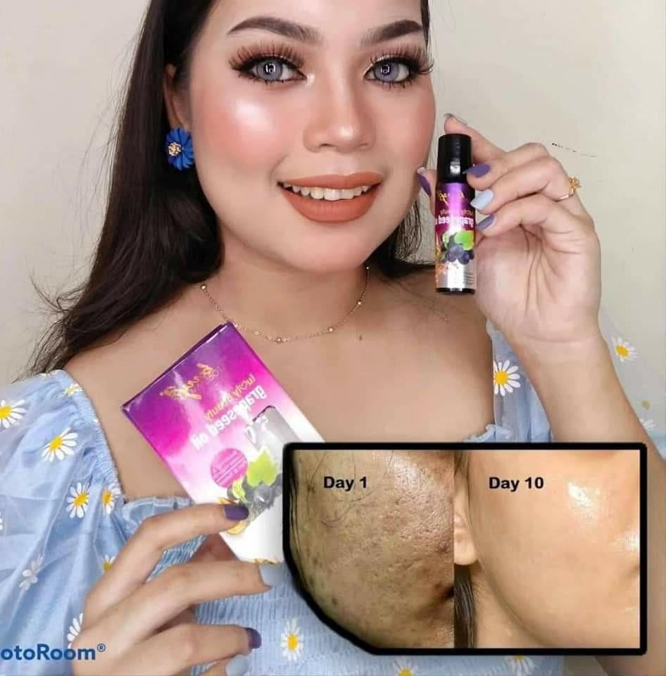 GRAPESEED OIL / ACNE / ECZEMA / EYEBAGS / DARK UNDER EYE / PIMPLE, Beauty & Personal Care, Face