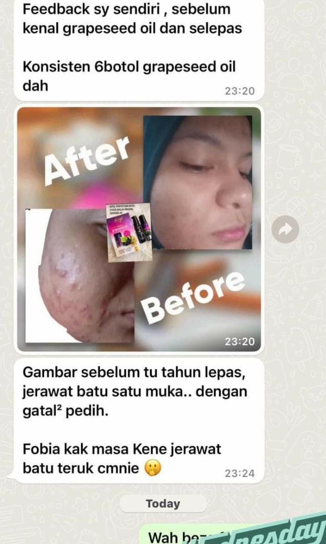 GRAPESEED OIL / ACNE / ECZEMA / EYEBAGS / DARK UNDER EYE / PIMPLE