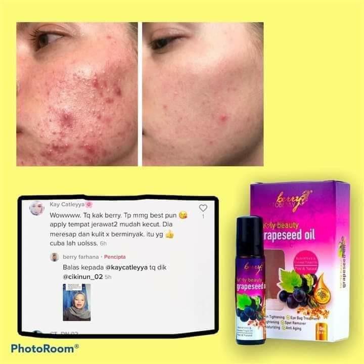 GRAPESEED OIL / ACNE / ECZEMA / EYEBAGS / DARK UNDER EYE / PIMPLE