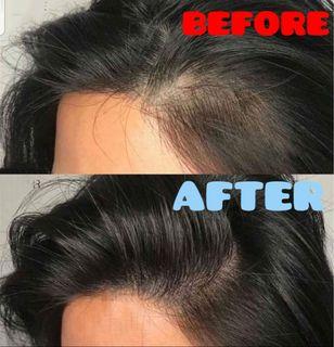 Hair Loss /Hair Fall - Natural Package 100% Results