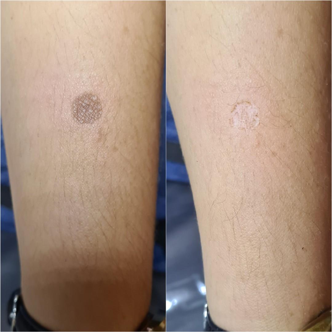 Mole wart milia seed skin tag oilclog scar removal tattoo removal