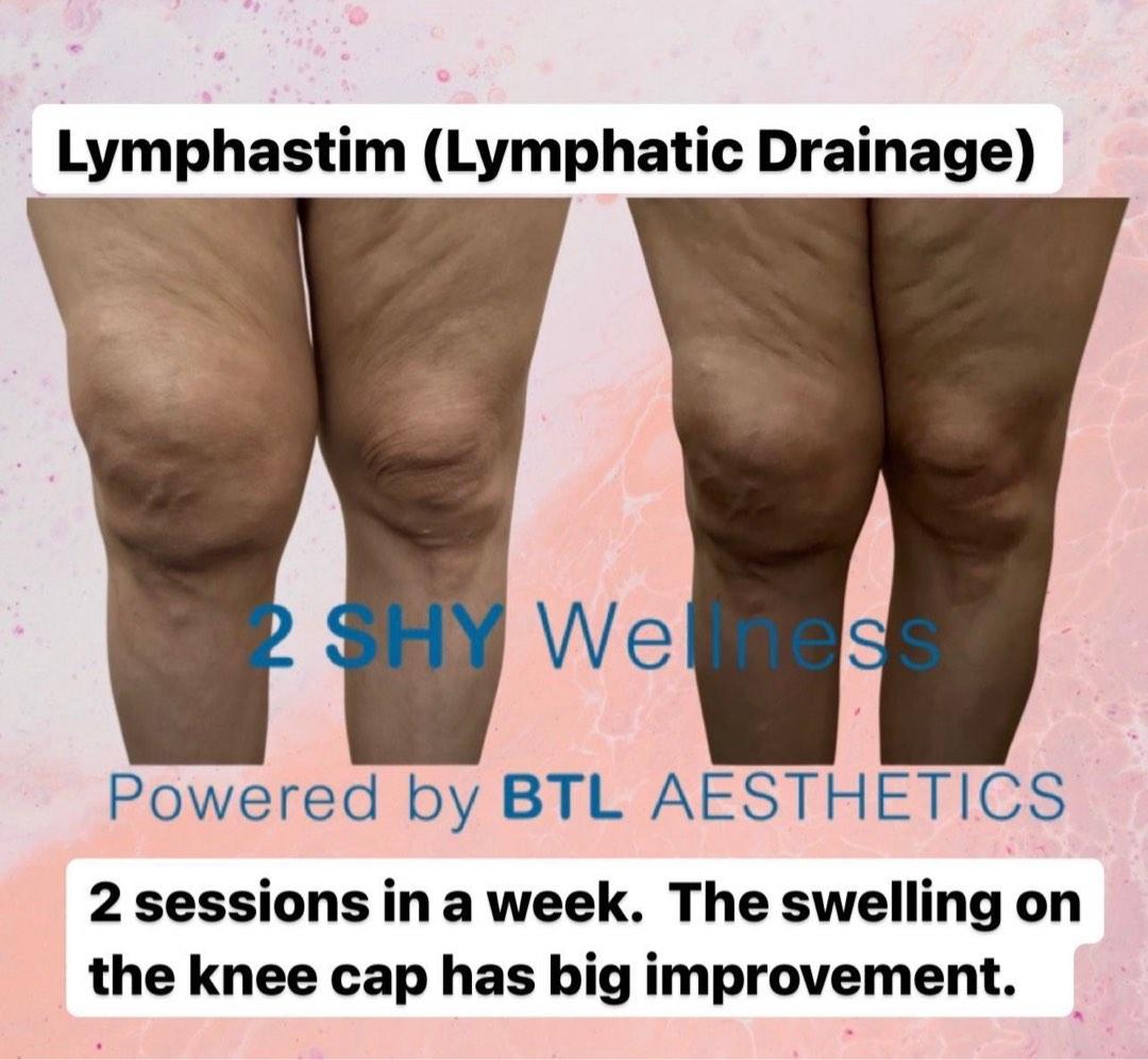 Hari Raya Promo Authentic BTL Lymphastim (Postnatal massage reduces