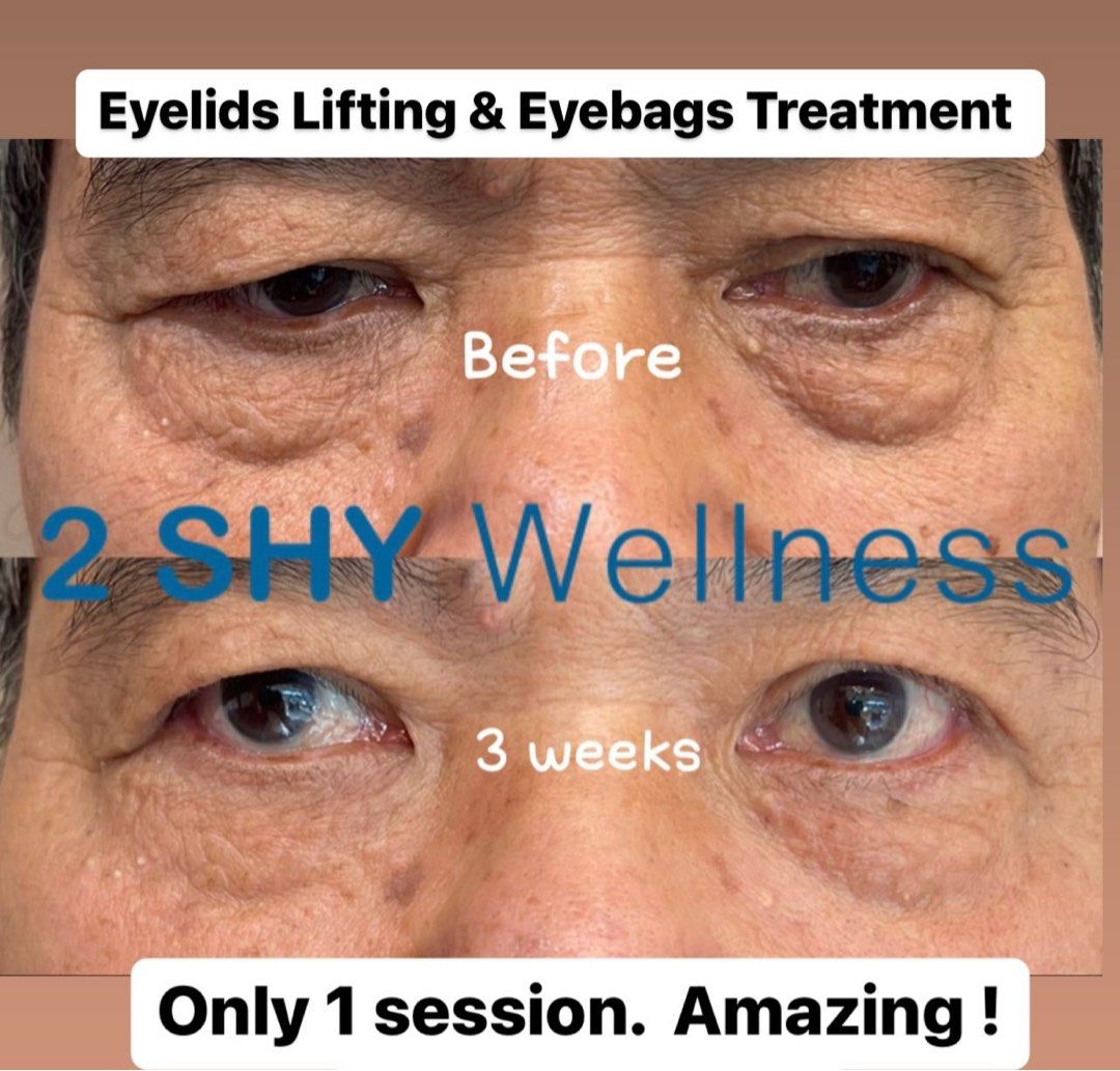 CNY Promo: FDA & HSA approved Medical Grade Eyelids Lift Treatment (4