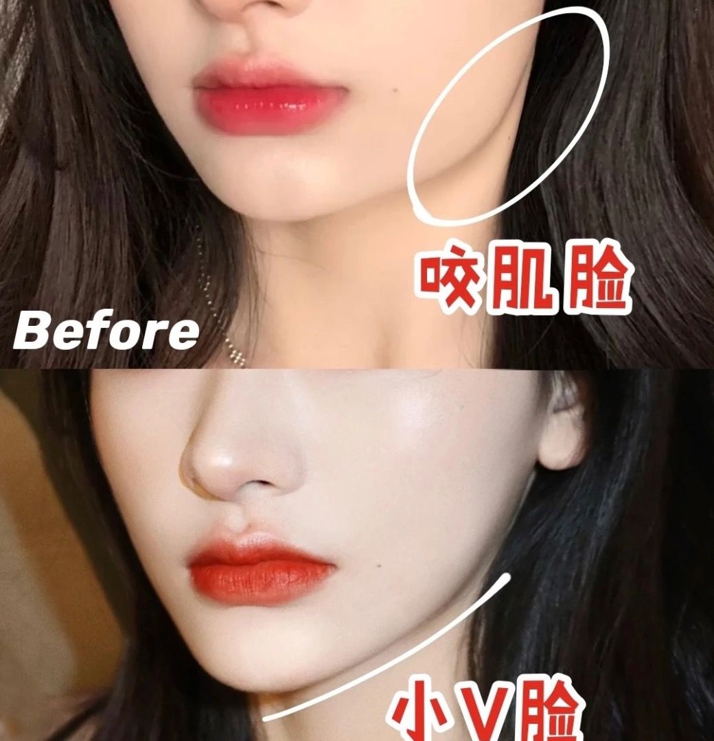 V face Lifting treatment, Beauty & Personal Care, Face, Face Care on ...