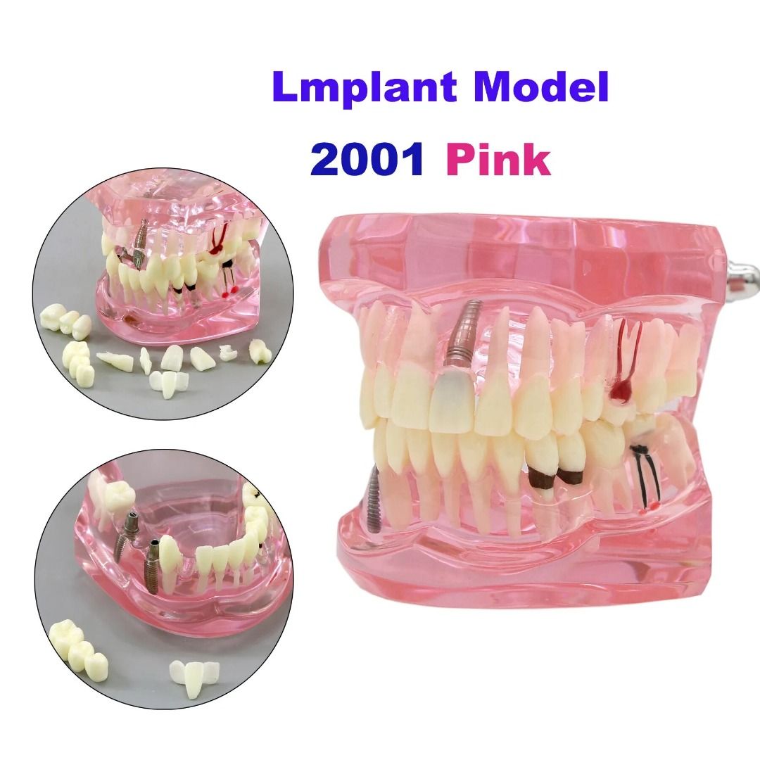 Dental Teeth Model Teaching Model Implant Disease Teeth Repair ...